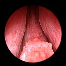 Уретроскопия. Сужение простатического отдела уретры узлами гиперплазии простаты.