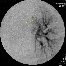 Рис.8 Селективная почечная артериограмма слева. Суперселективная эмболизация сегментарных артерий, питающих ангиомиолипому микроспиралью Gianturko (стрелка).
