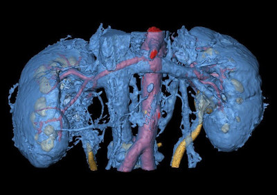 3D-моделирование патологического процесса. Анатомия сосудов почек.