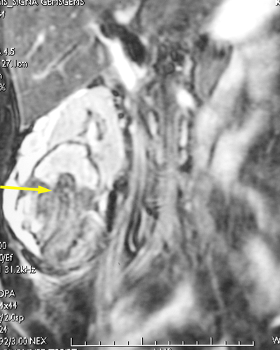 МР-томограмма. Разрыв опухоли нижнего сегмента почки с кровоизлиянием в подострой фазе (указана стрелкой).