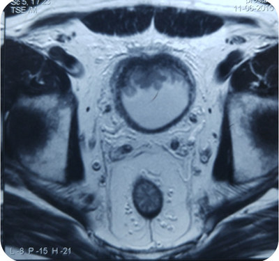 МРТ малого таза с контрастированием – опухоль мочевого пузыря