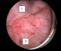 Интраоперационная фотография (обычная цистоскопия): 1 – опухоль мочевого пузыря; 2 – устье правого мочеточника.