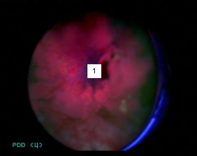 Интраоперационная фотография (фотодинамическая цистоскопия): 1 – опухоль мочевого пузыря.