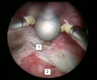 Интраоперационная фотография (обычная цистоскопия): 1 — стенка мочевого пузыря после удаления опухоли, 2 – устье правого мочеточника.