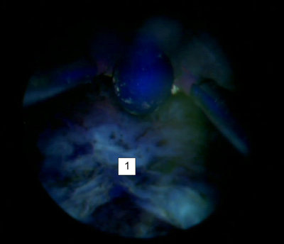 Интраоперационная фотография (фотодинамическая цистоскопия): 1 — стенка мочевого пузыря после удаления опухоли.