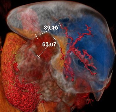 Вид спереди. Измерена глубина инвазии опухоли почки в 7 сегмент печени и расстояние до крупной артериальной ветви печени.