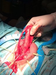 Взятие уретры (А) на держалку. Подготовка уретральной площадки для трансплантации.