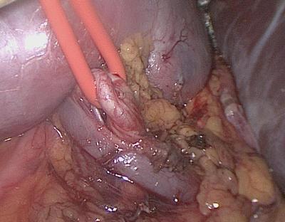 Лапароскопическая резекция правой почки с опухолью. Выделена и взята на держалку правая почечная артерия.