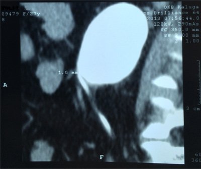МСКТ. Гидронефроз слева. Резкое сужение прилоханочного отдела мочеточника до 1 мм